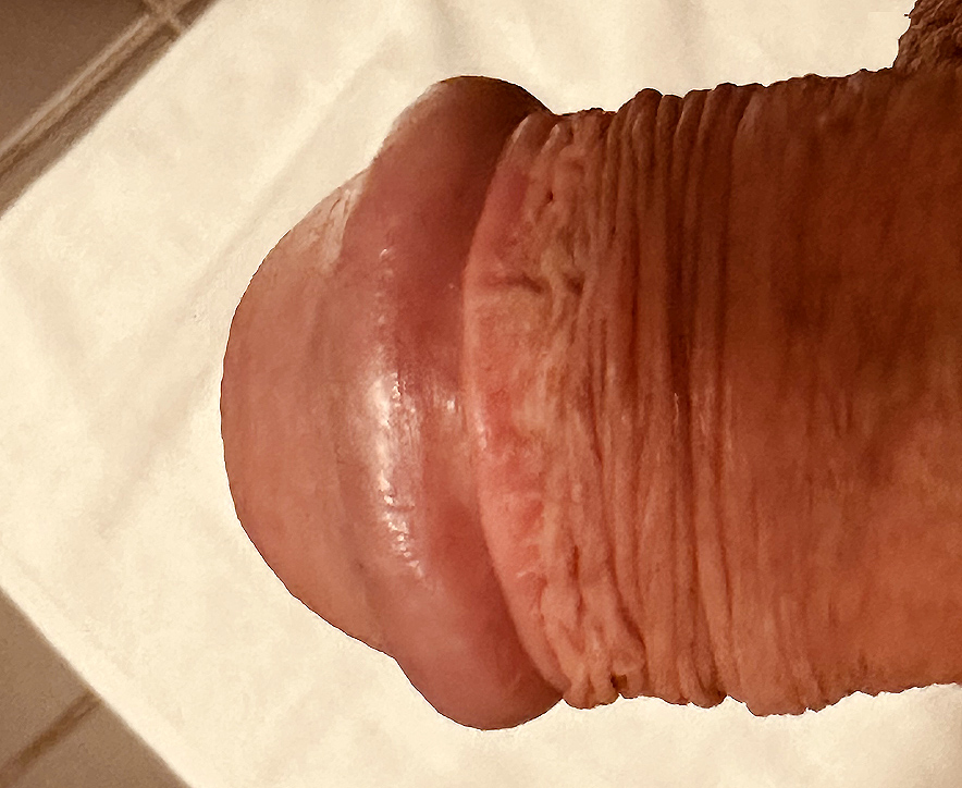 obřízka penisu u mužů